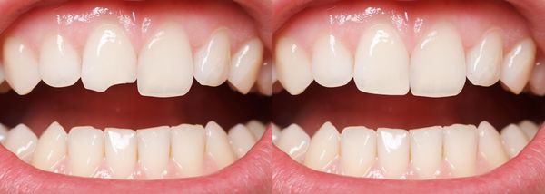 Before and after dental bonding photos