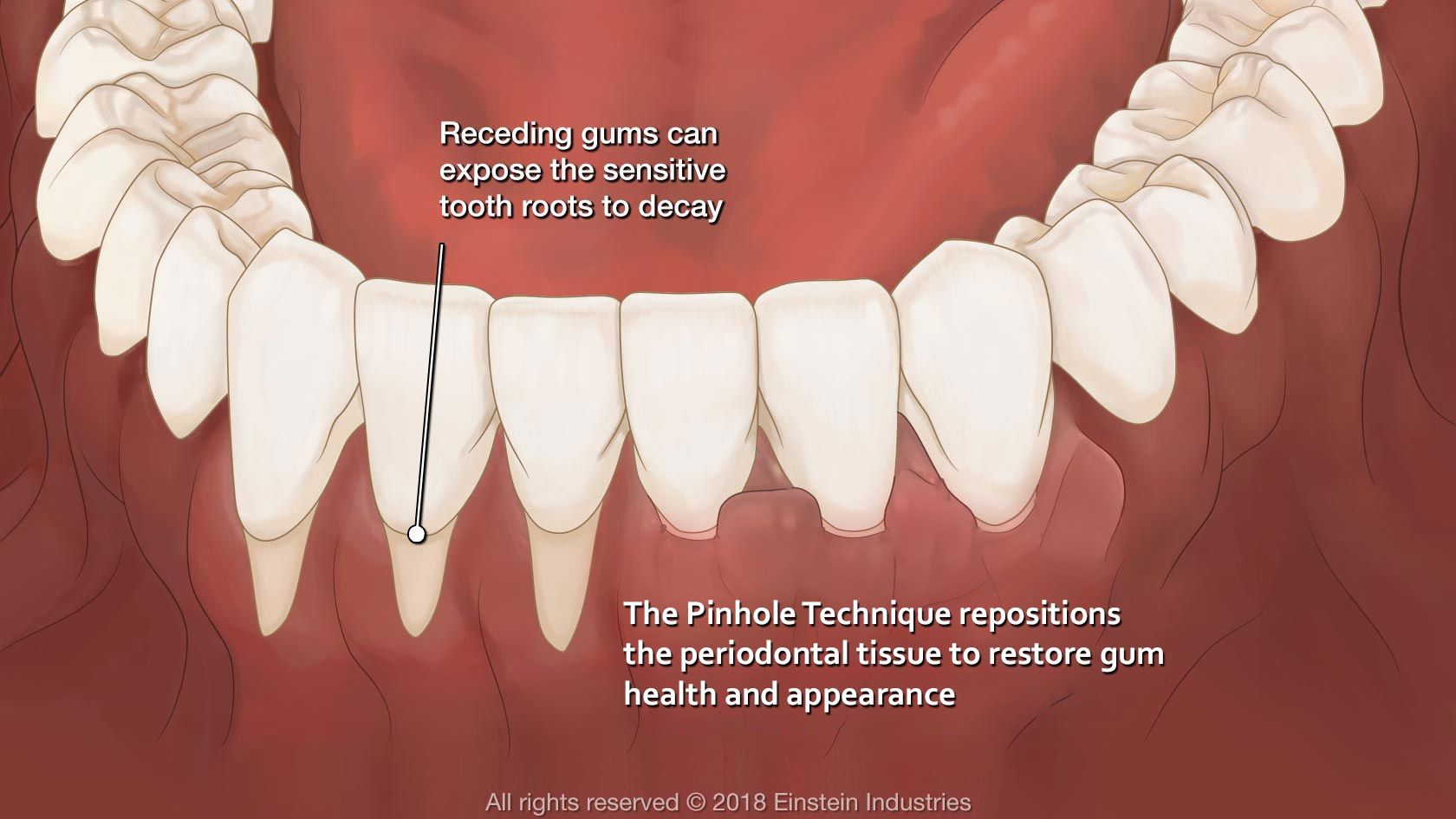 Pinhole gum surgery illustration